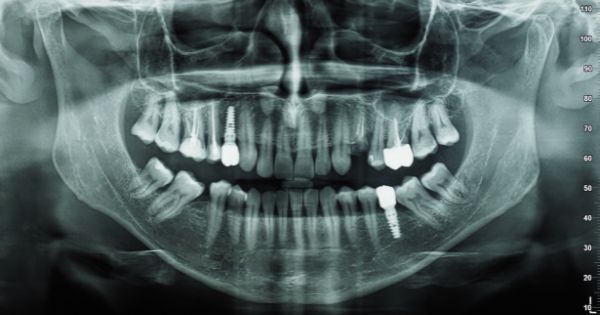 dentiahorro cirugía dental xalapa veracruz