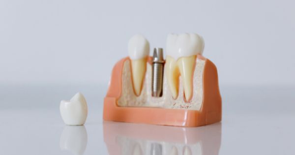 dentiahorro implantes dentales xalapa veracruz